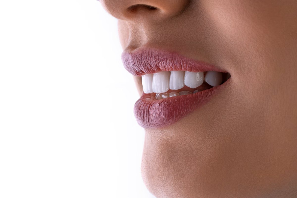 Teeth after treatment (demo)