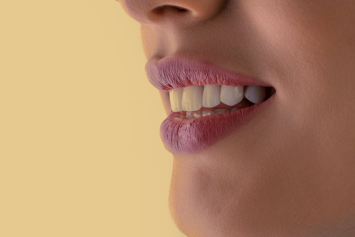 Teeth before treatment (demo)