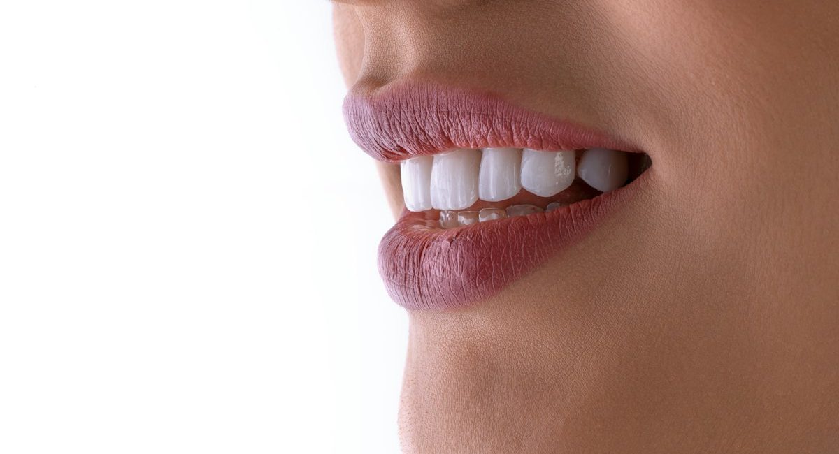 Bright white smile after whitening