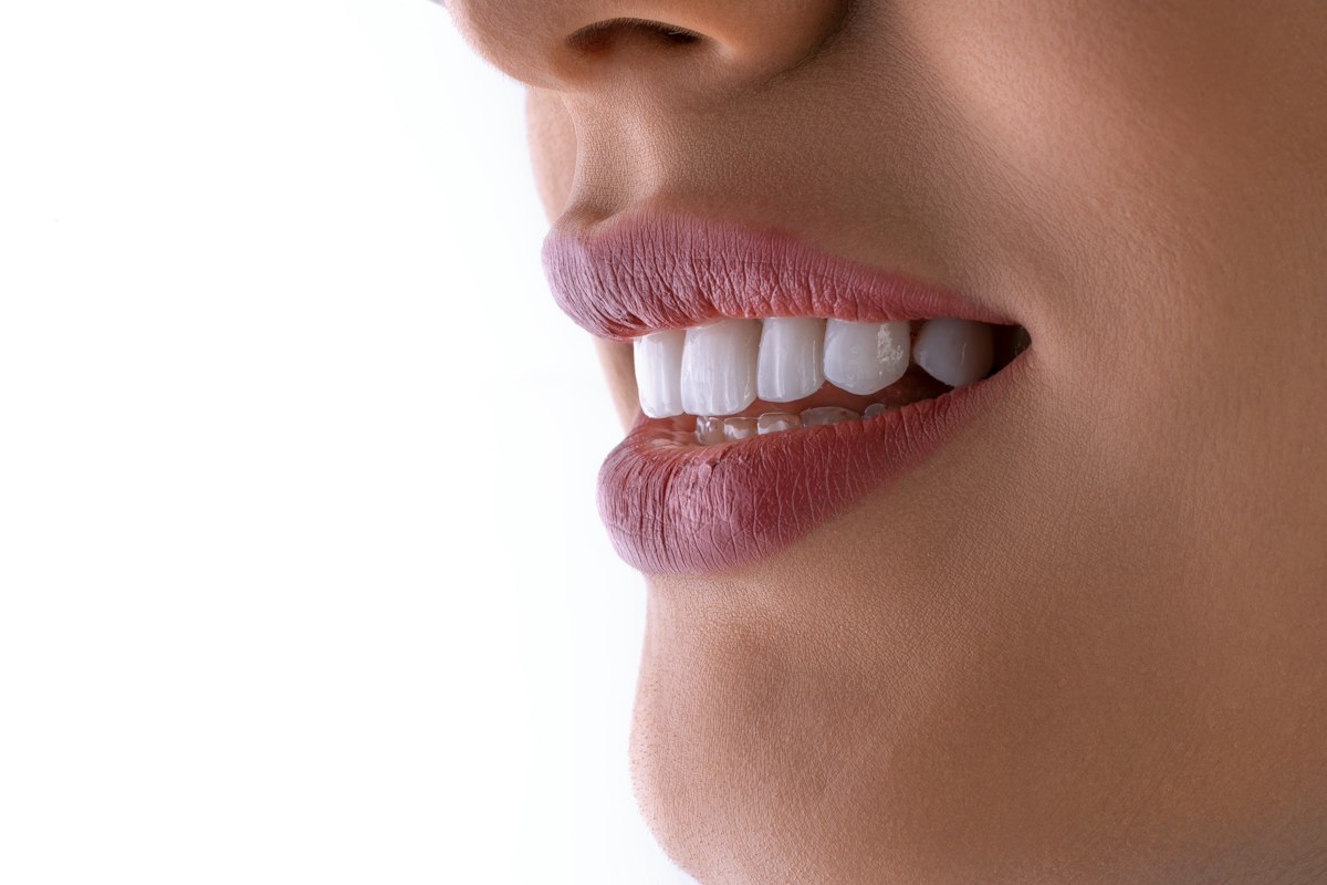 Bright white smile after whitening